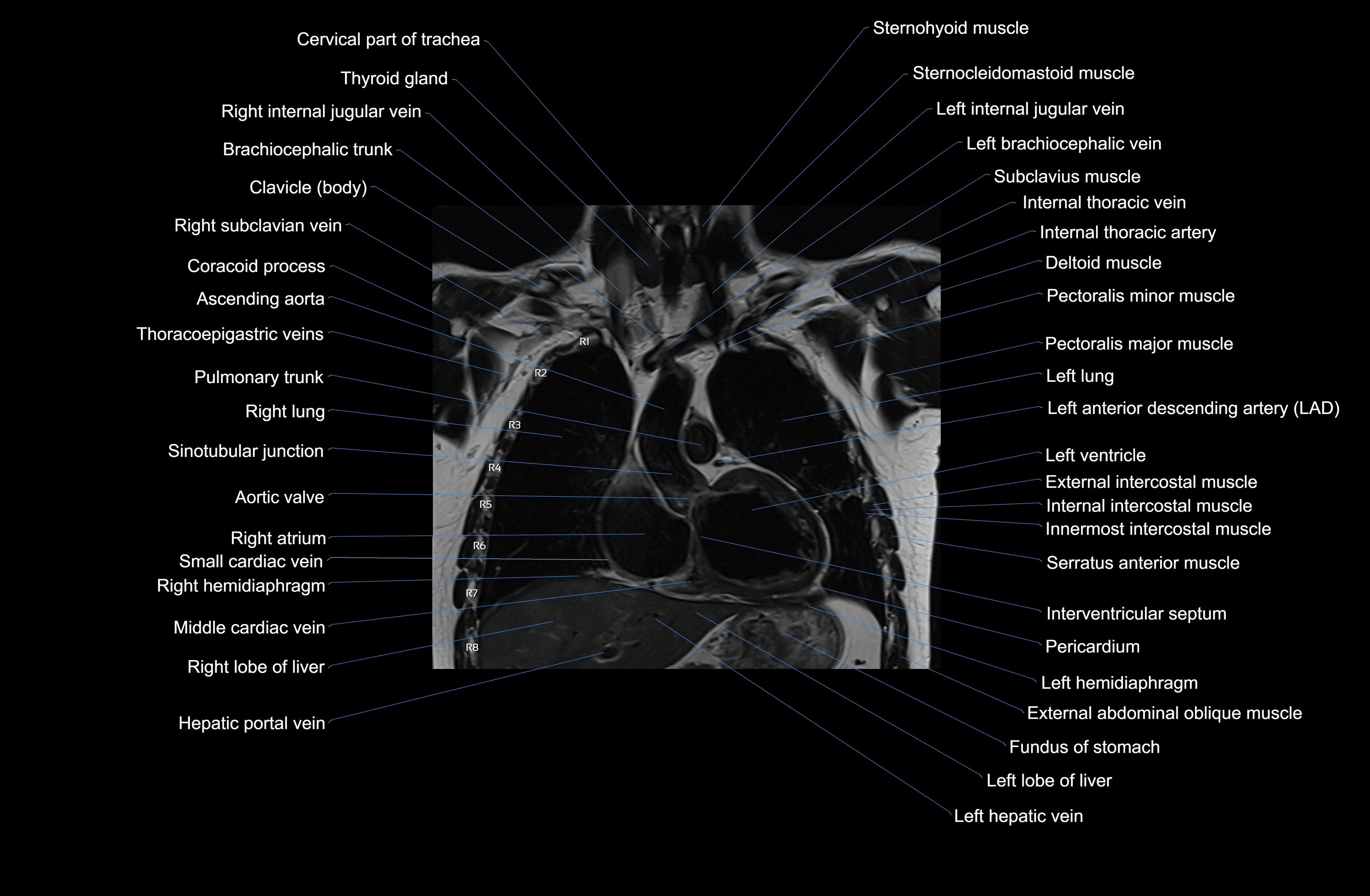 MRI chest (thorax) coronal  cross sectional anatomy 3T radiology  image-img-00001-00016.webp
